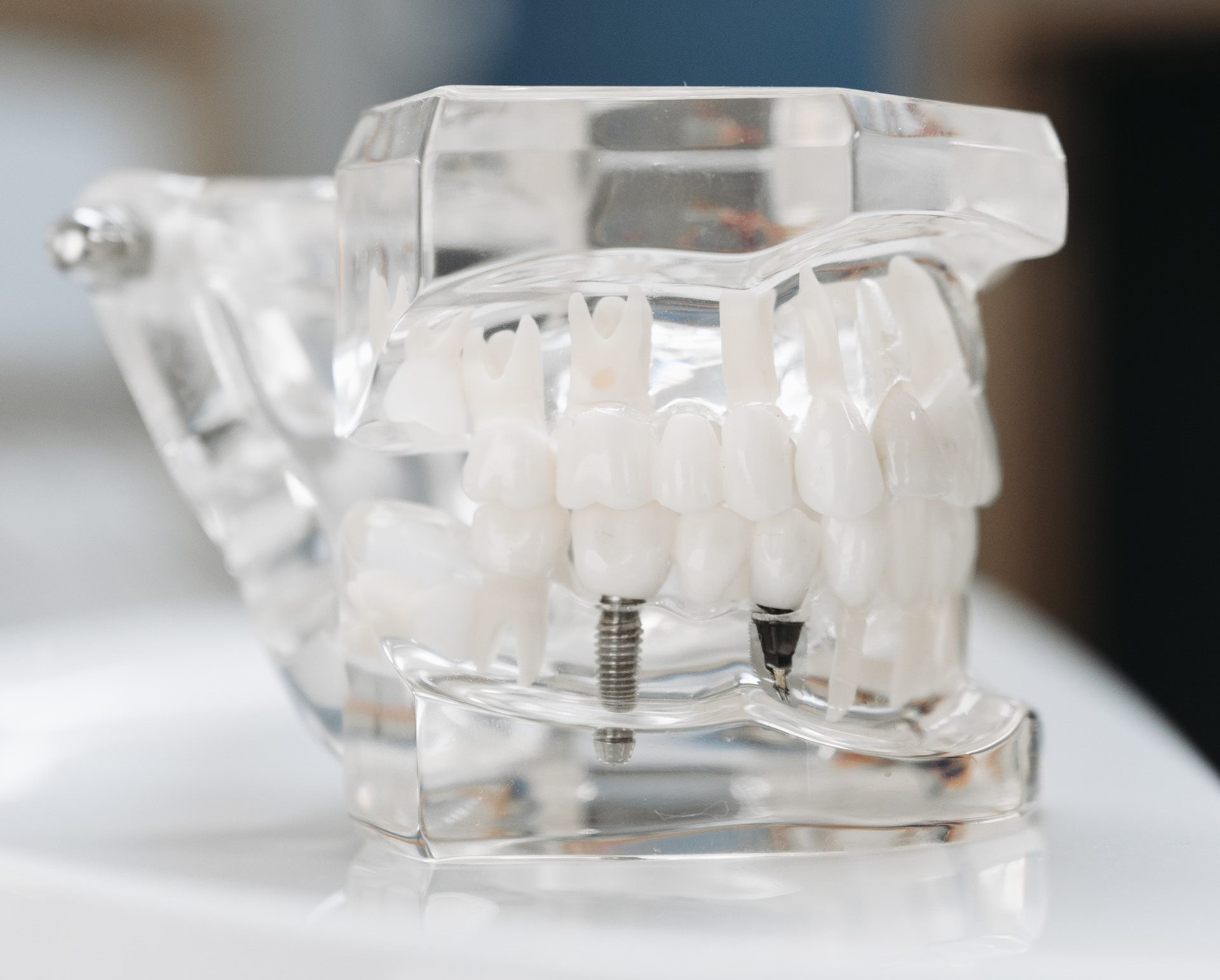 missing_teeth_dental_implants_Frederick_dentist